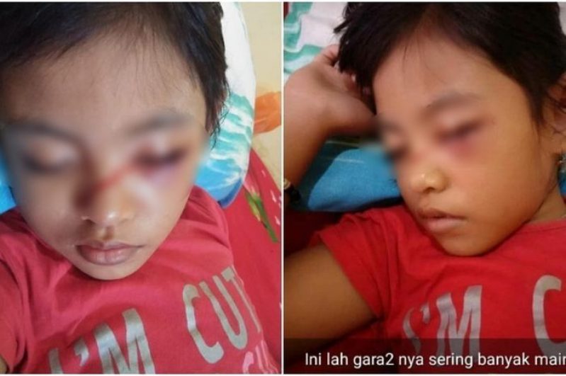 Pelajaran Bagi Orangtua, Mata Anak Ini Lebam dan Keluar Darah Akibat Kecanduan Main Ponsel